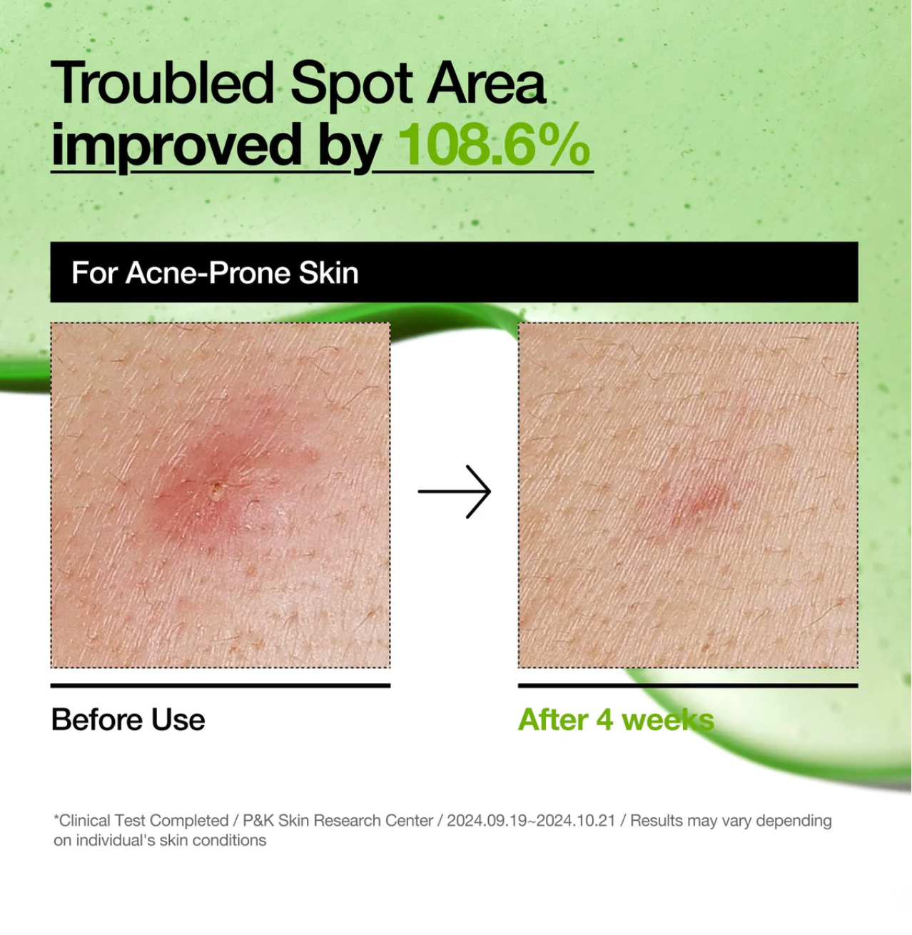 Anua Azelaic Acid 10 Hyaluron Redness Soothing serum 30ml - Suunsu Korean skincare